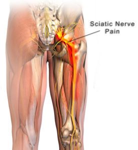 sciatic nerve pain 