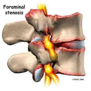 foraminal stenosis