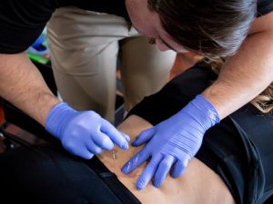 doctor with gloves on doing a Dry Needling Treatment on a patients back