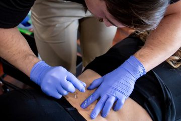 doctor with gloves on doing a Dry Needling Treatment on a patients back