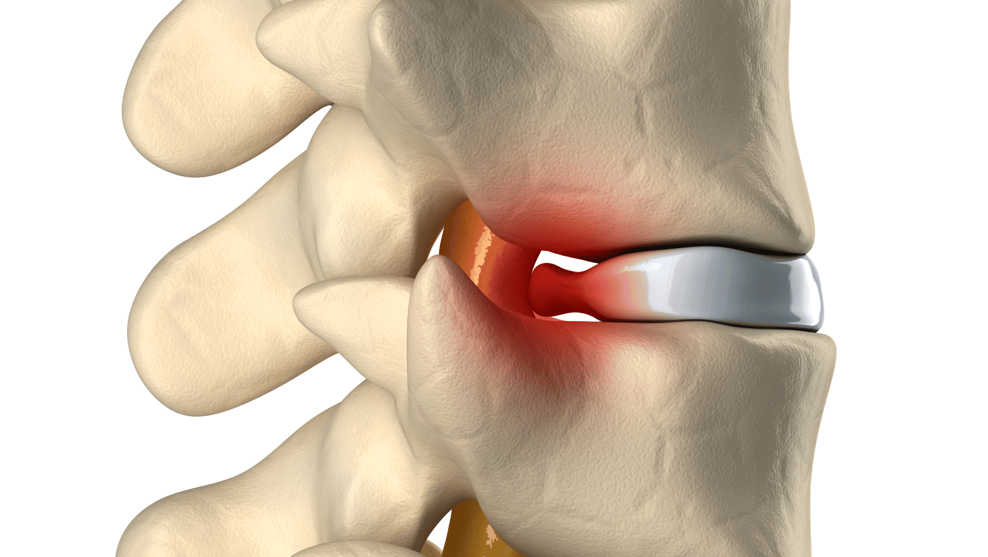 herniated disc that needs spinal decompression therapy for relief 